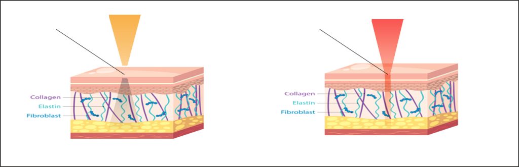 Illustration comparing how plasma energy and laser energy interact differently with deeper skin tissue