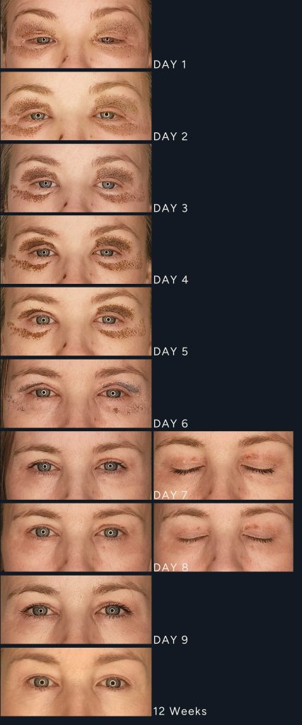 Plexr Eyelid plasma treatment healing progression days 1 to 9 showing carbon crusting and early recovery response