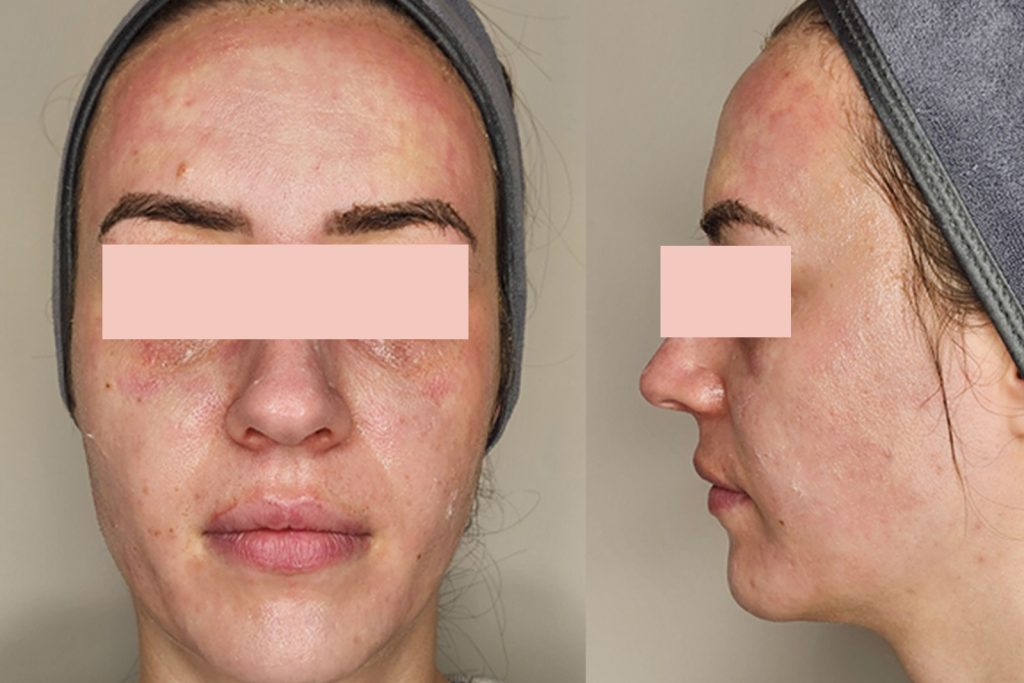 Full face immediately after NeoGen plasma treatment showing uniform redness as part of the natural healing response