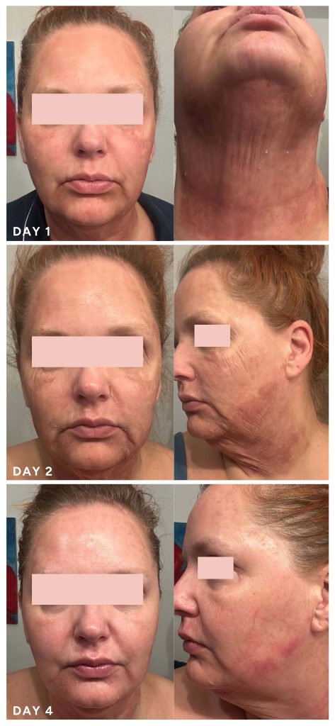 NeoGen plasma treatment healing progression days 1 to 4 showing redness and early recovery response