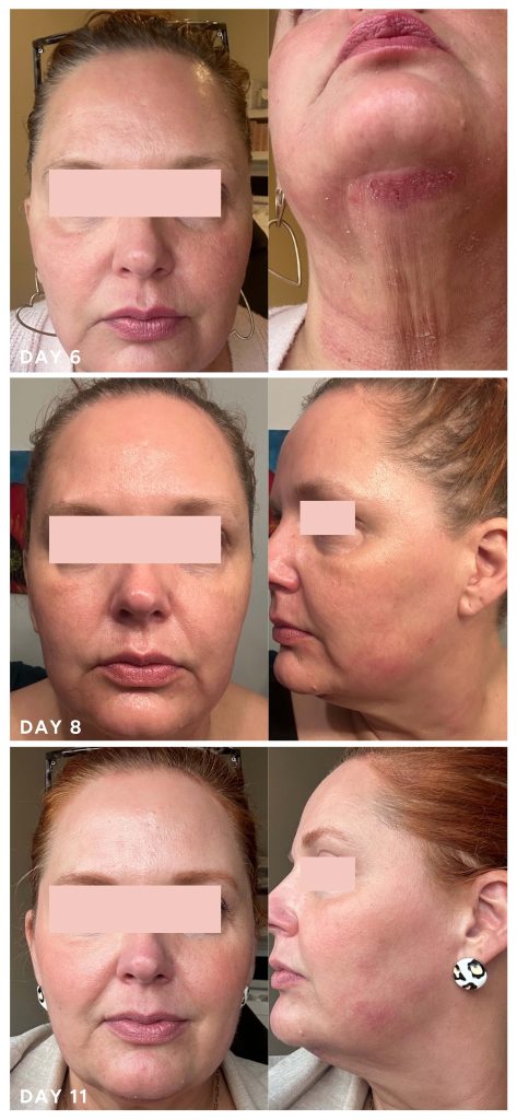 NeoGen plasma treatment healing progression days 6 to 11 showing reduced redness and continued skin renewal