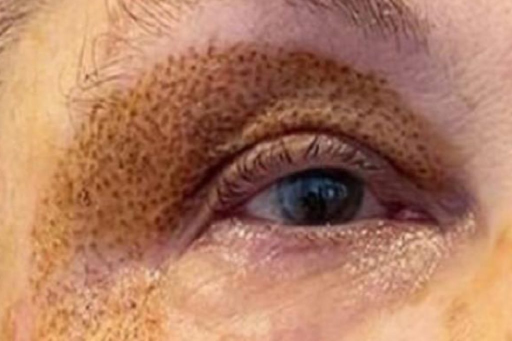 Close up of eyelid immediately after Plexr plasma treatment showing carbon crust formation as part of the natural healing process.