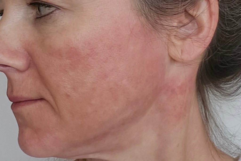 Lower face immediately after NeoGen plasma treatment showing expected redness and healing response
