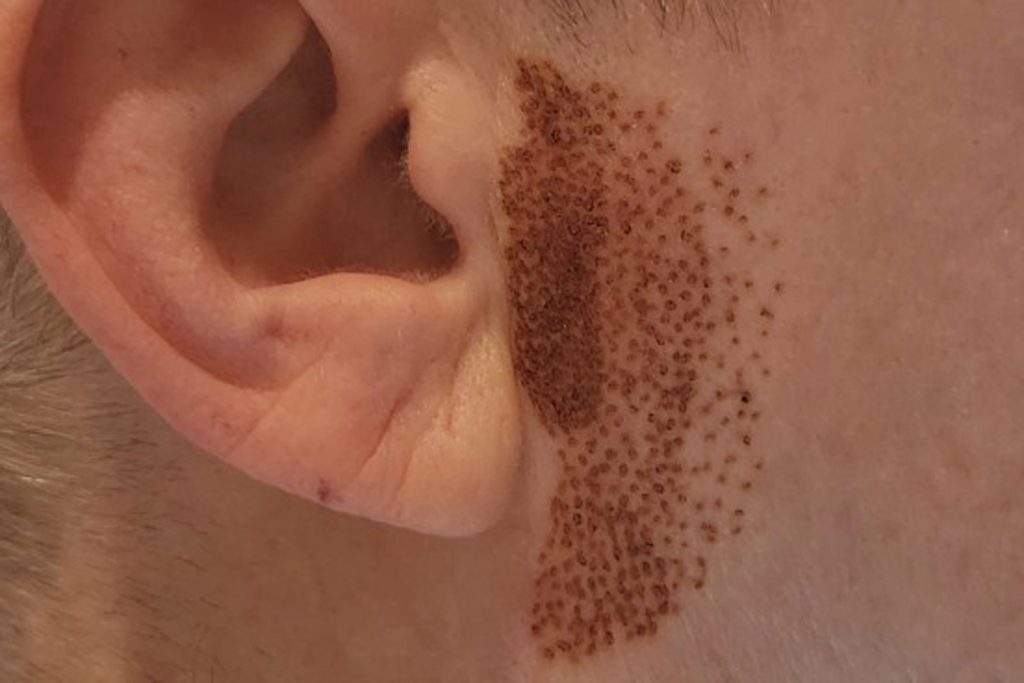 Plexr plasma treatment for skin tightening and wrinkle reduction around the ear area