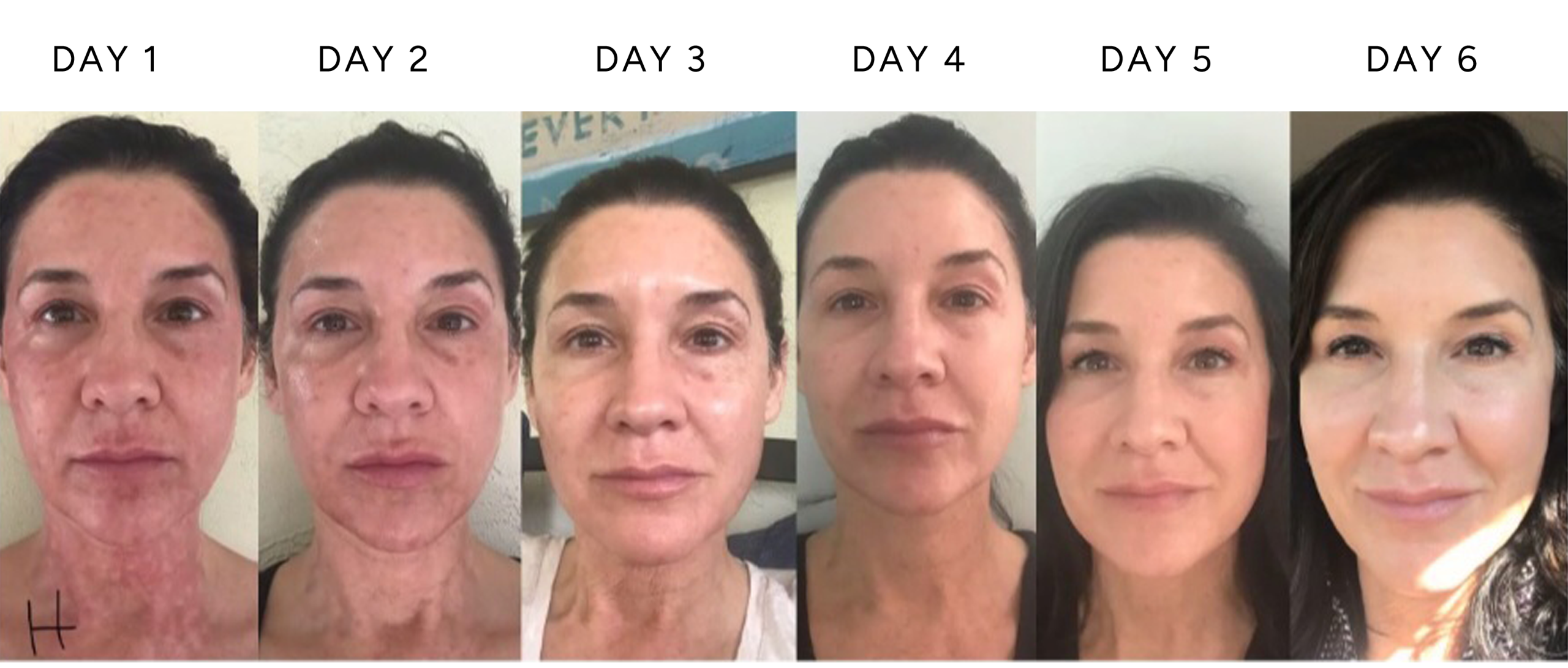 NeoGen plasma treatment healing timeline showing full face and neck recovery from days 1 through 6 following 0.8 energy treatment