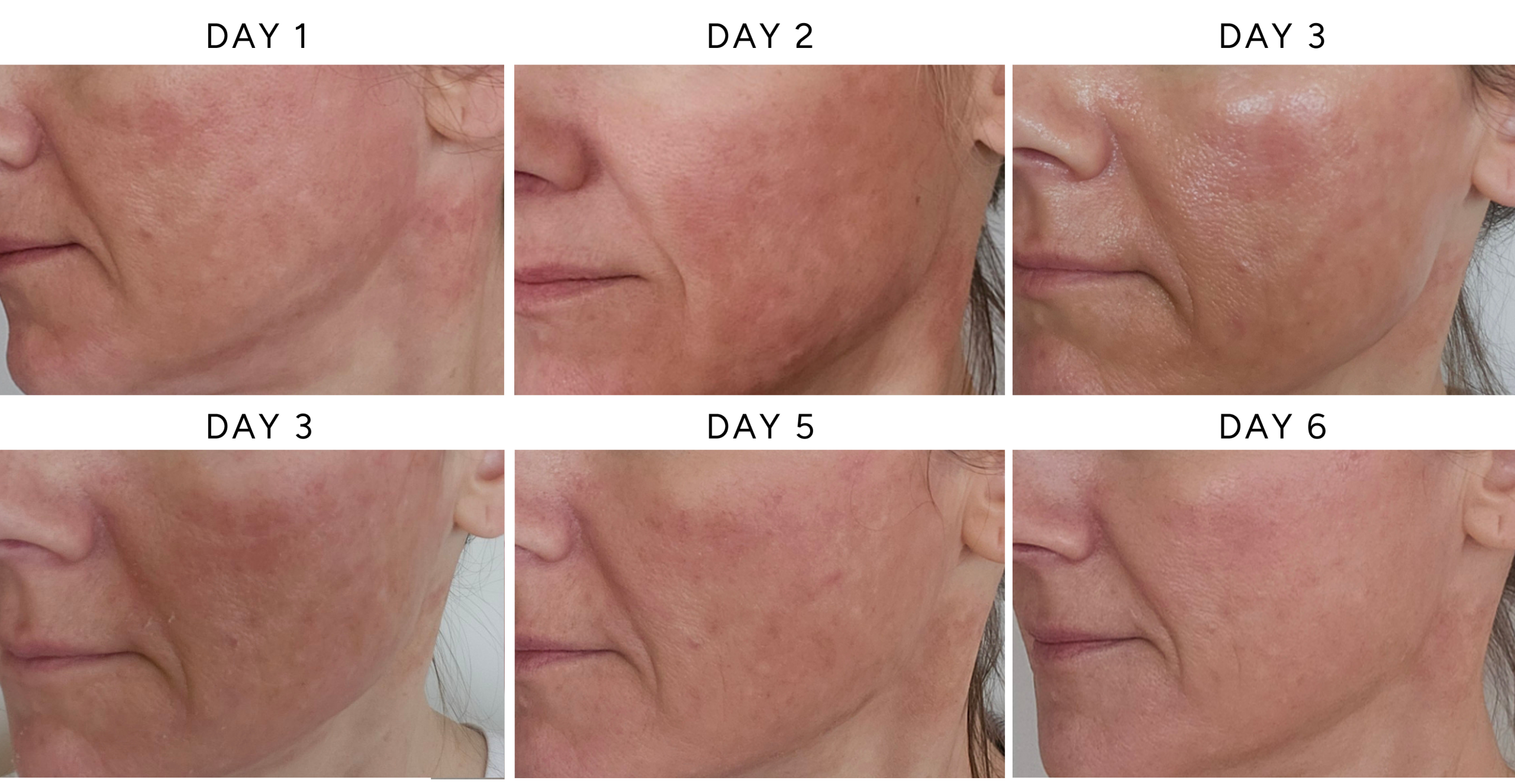 NeoGen plasma treatment healing timeline showing lower face recovery from days 1 through 6 with redness, bronzing, and gentle peeling