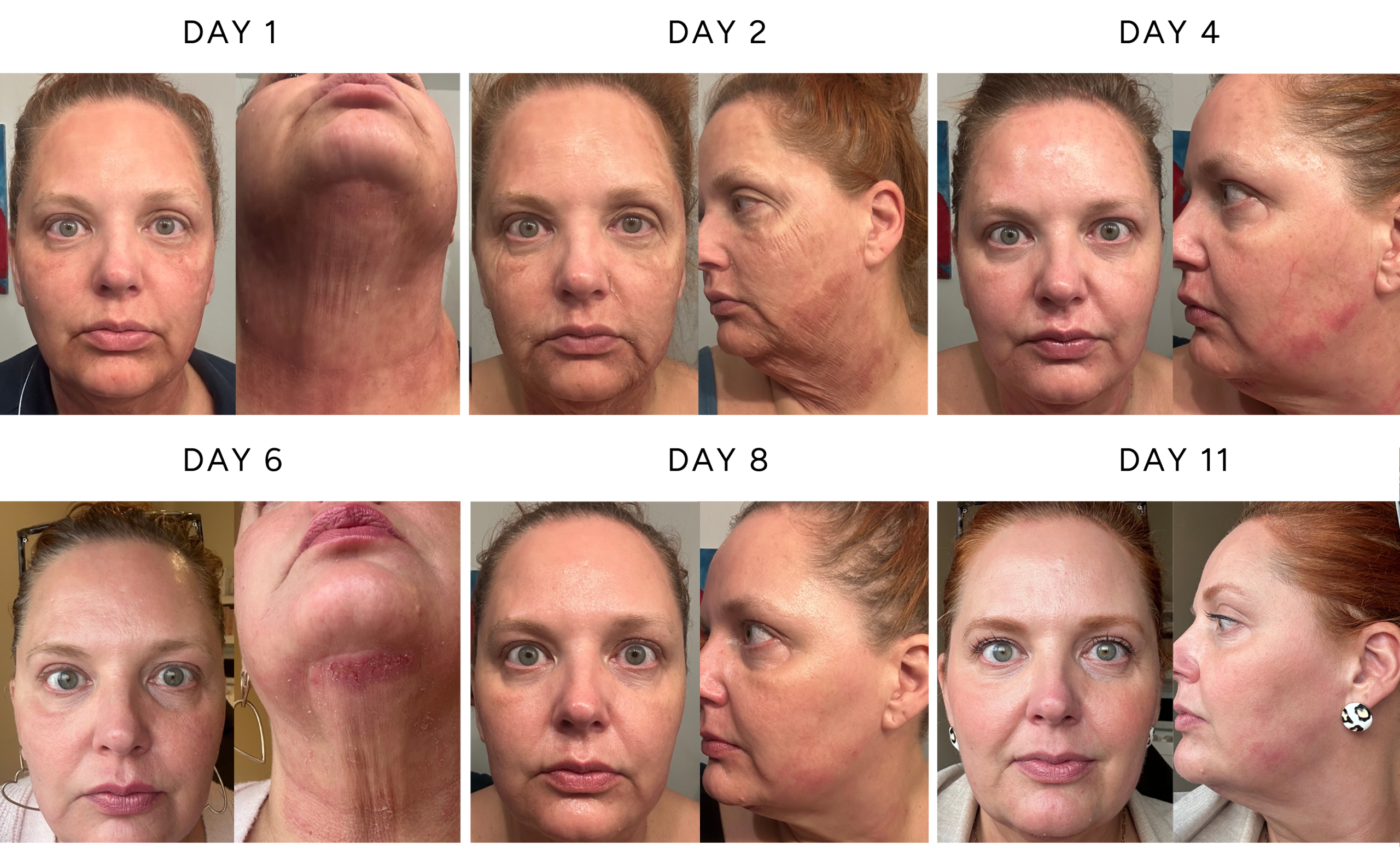 High-energy NeoGen plasma treatment healing timeline showing facial recovery from days 1 through 11 with skin tightening and regeneration
