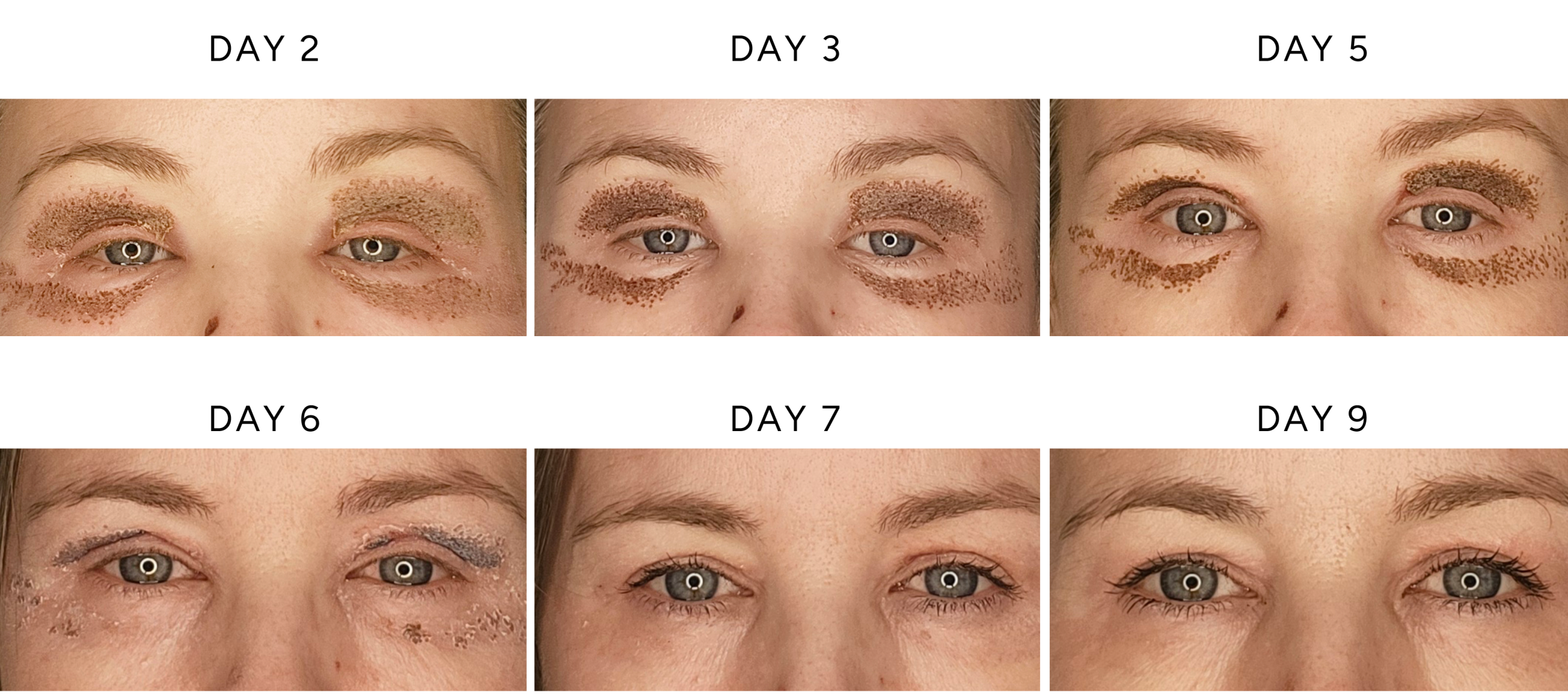 Plexr eyelid treatment healing progression showing upper and lower eyelid recovery, carbon crusting, and normal healing response from days 1–9