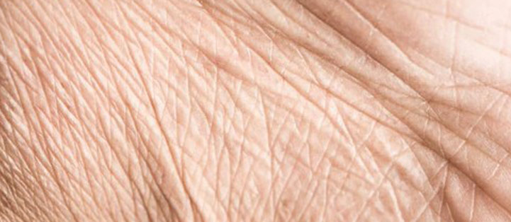 Close-up of crepey skin showing fine lines, thinning skin, and reduced elasticity.