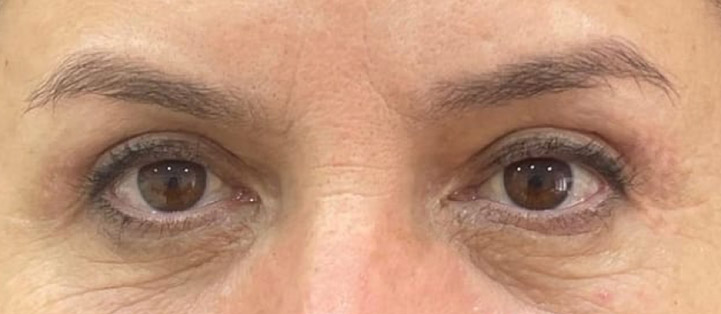 After Plexr plasma treatment showing improvement in hooded upper eyelids, excess upper eyelid skin, and upper eyelid laxity.