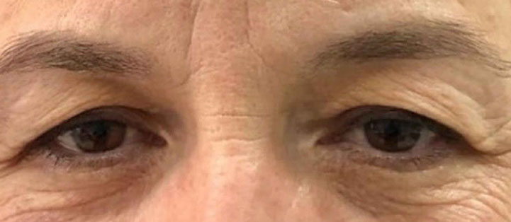 Before Plexr plasma treatment showing hooded upper eyelids, excess upper eyelid skin, and age-related eyelid laxity.
