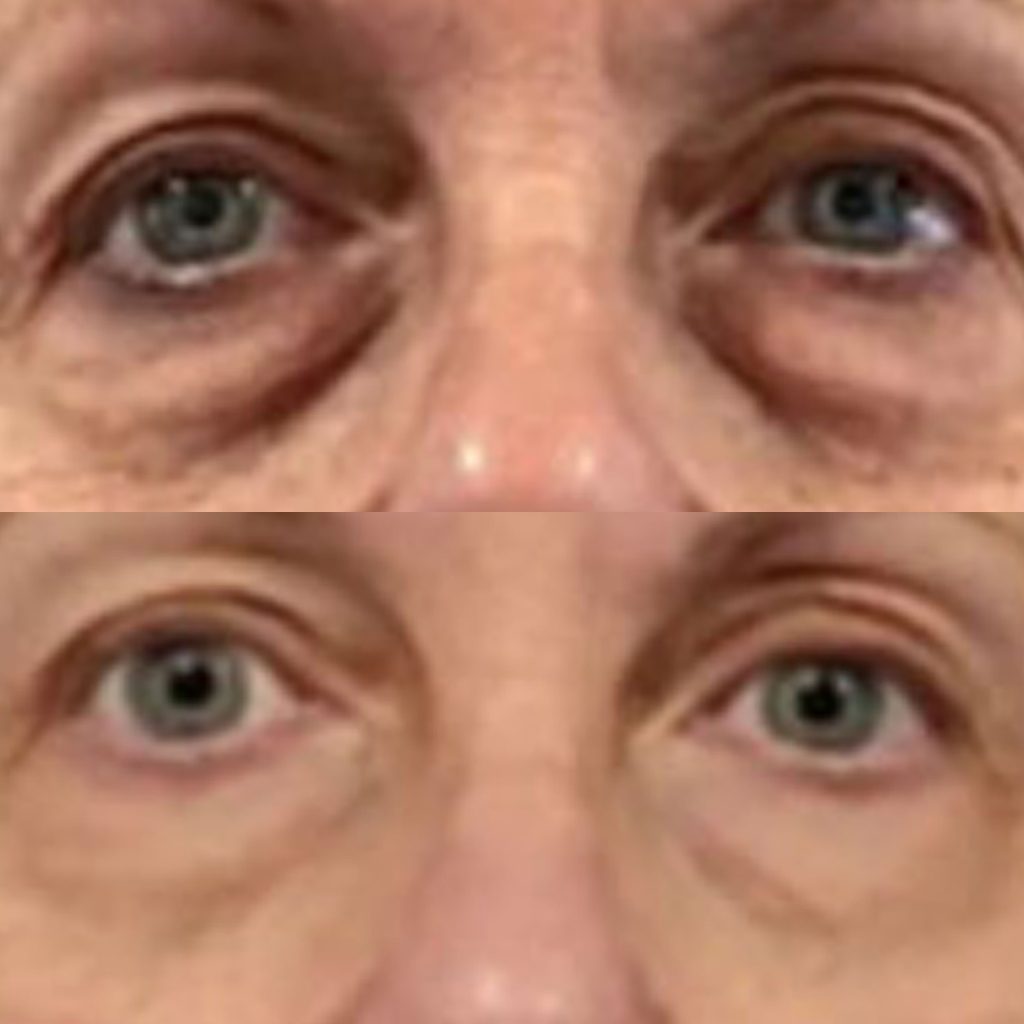 Before-and-after NeoGen Plasma Skin Regeneration treatment showing improvement in under-eye bags, lower eyelid skin laxity, and excess lower eyelid skin.