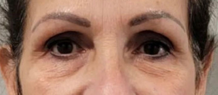 Before NeoGen Plasma Skin Regeneration treatment showing under-eye bags, the appearance of dark circles, and age-related skin laxity beneath the eyes.