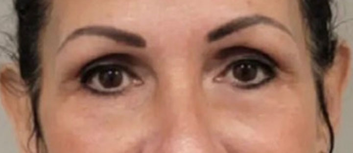 After NeoGen Plasma Skin Regeneration treatment showing improvement in under-eye bags, skin laxity, and the appearance of dark circles.