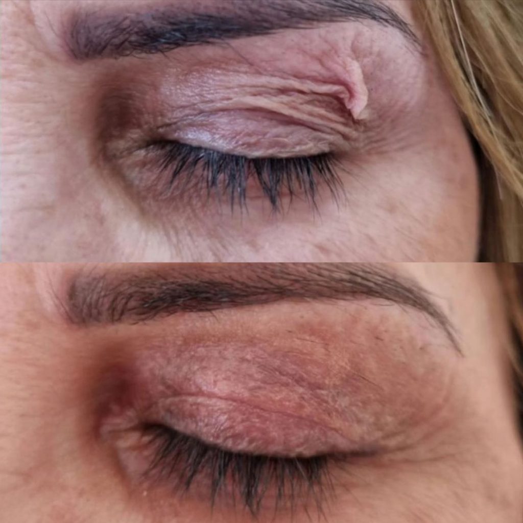 Before-and-after Plexr non-surgical upper eyelid blepharoplasty showing reduced excess upper eyelid skin and improvement in hooded eyelids and eyelid laxity.
