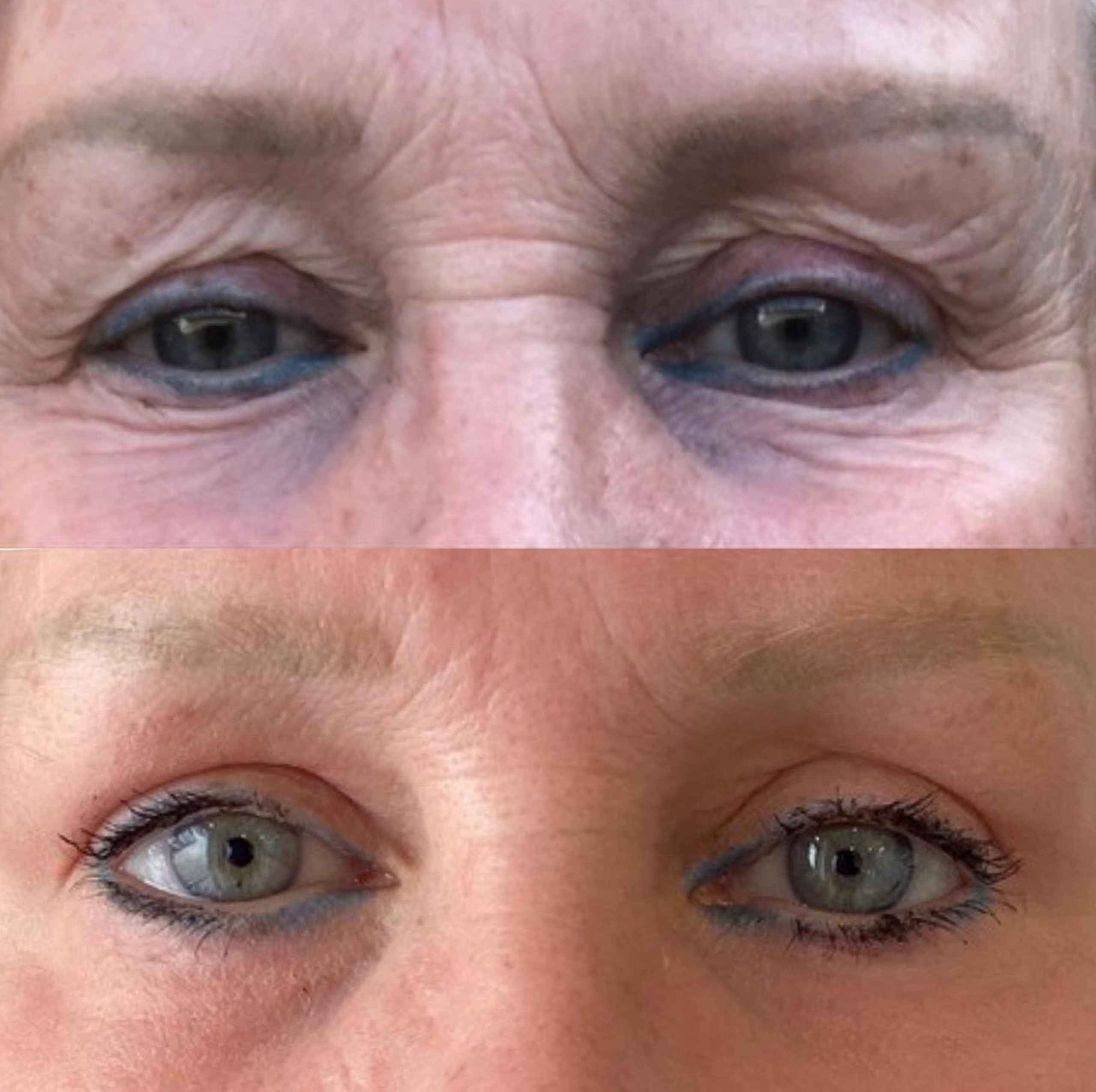 Before-and-after Plexr plasma treatment for upper and lower eyelid tightening with improved skin laxity and eye rejuvenation.