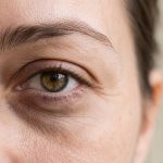 Close-up of an eye showing under-eye dark circles and fine lines
