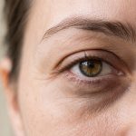Close-up of an eye showing under-eye dark circles and fine lines