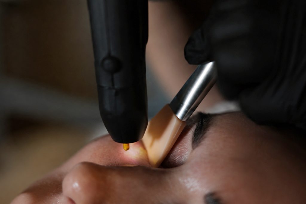 NeoGen or Plexr treatment being applied to the under-eye area