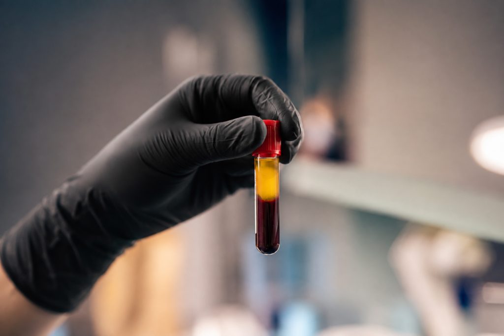 Centrifuged blood sample showing separated PRP layer, used to prepare platelet-rich plasma treatment