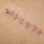 Fresh sutured surgical incision on the skin