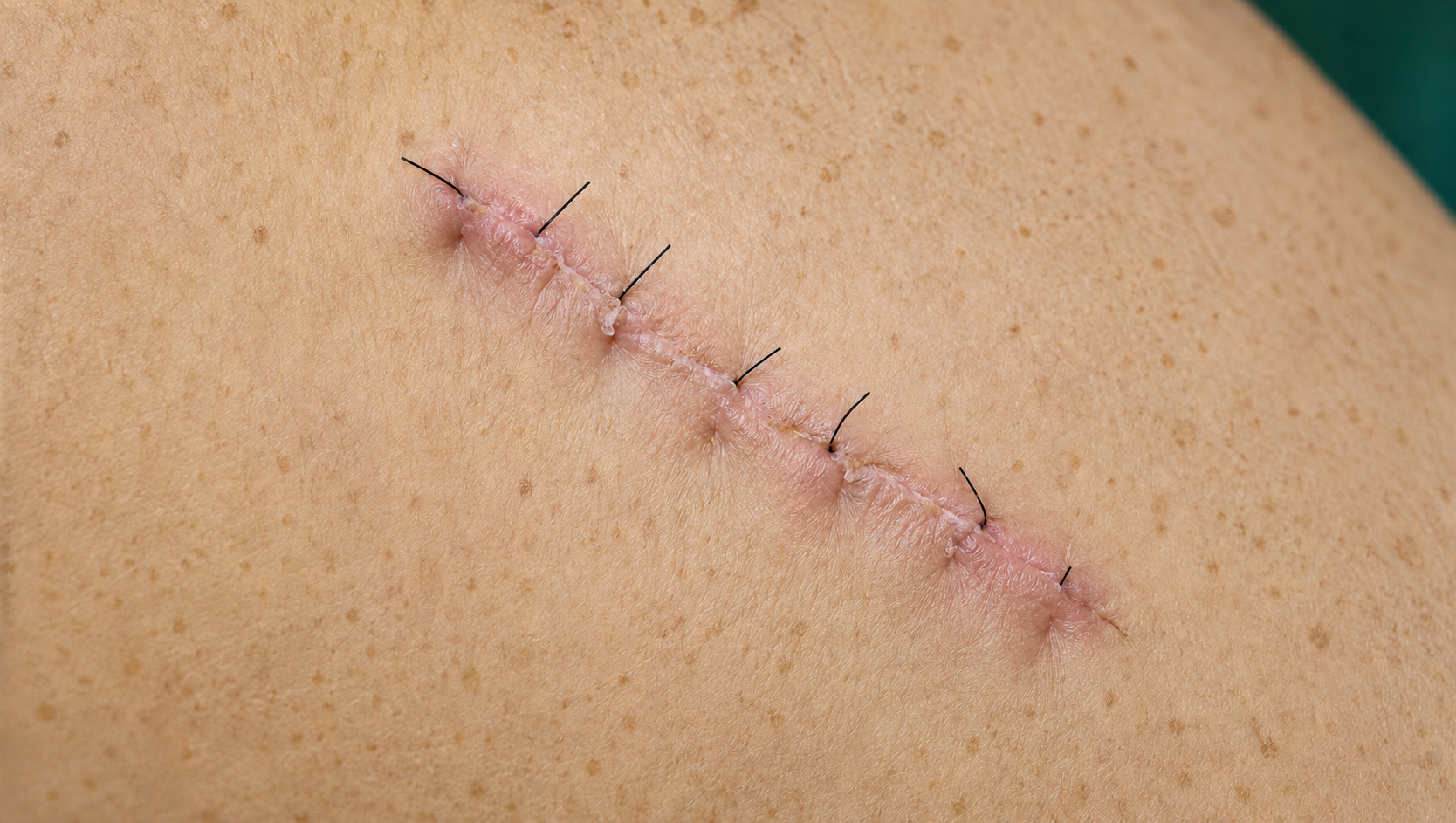 Fresh sutured surgical incision on the skin
