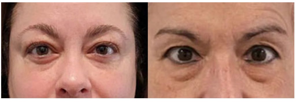 Two close-up examples of under-eye dark circles showing different presentations