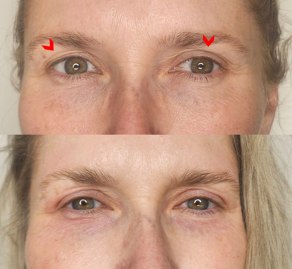 Front view of a woman's eye area before Plexr eyelid treatment and at Day 13, with light pinkness on the upper and lower eyelids