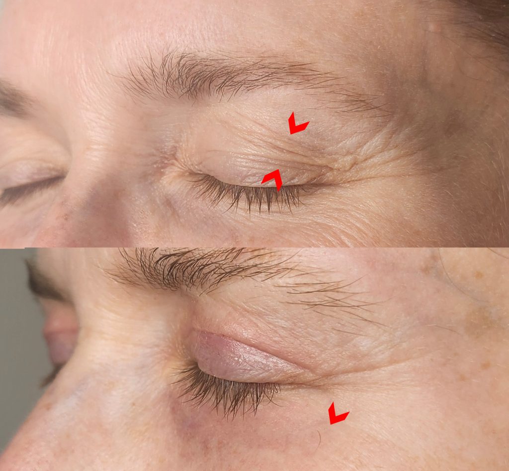 Left side view of a woman's eye area before Plexr eyelid treatment and at Day 13, with light pinkness on the upper and lower eyelids