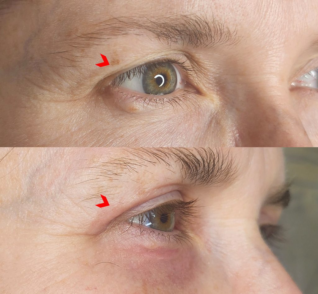 Right side view of a woman's eye area before Plexr eyelid treatment and at Day 13, with light pinkness on the upper and lower eyelids
