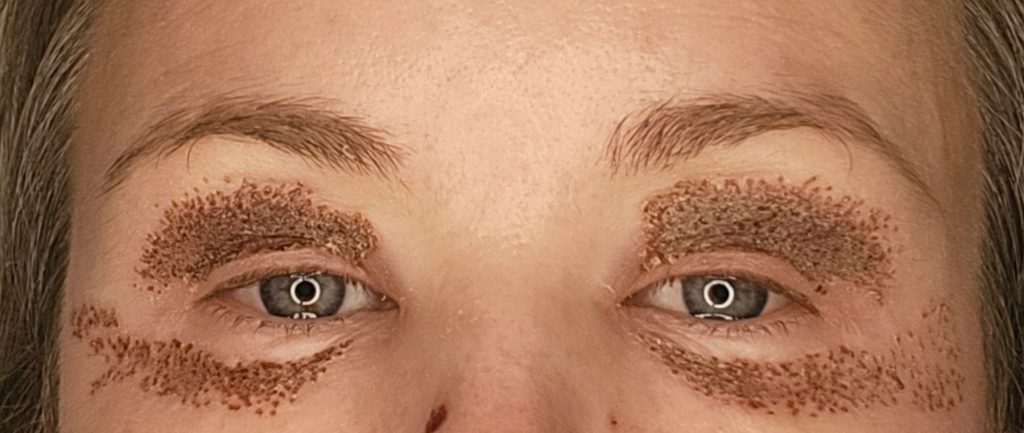 Day 3 healing after Plexr upper and lower eyelid treatment showing swelling and carbon crusts