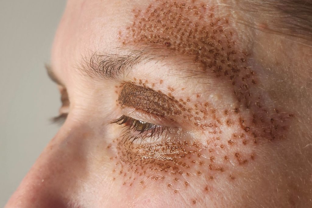 Immediately after Plexr upper and lower eyelid treatment showing fresh carbon crusts