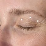 Upper eyelid laxity with arrows showing loose skin weighing down over the eyelid