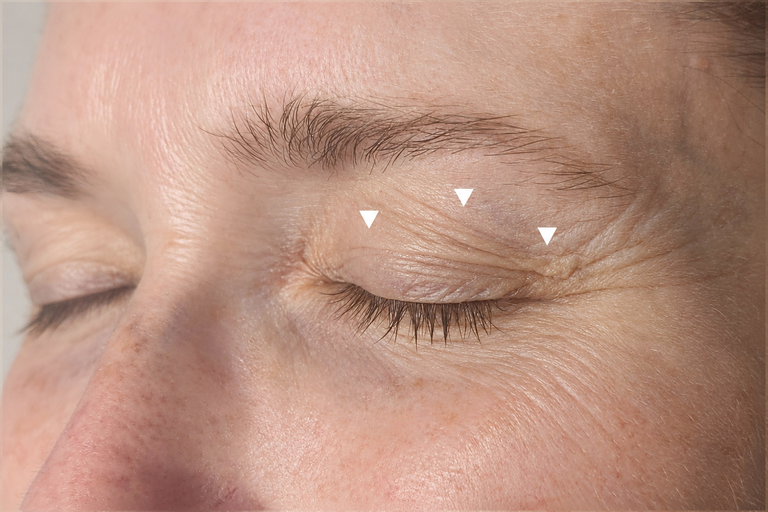 Upper eyelid laxity with arrows showing loose skin weighing down over the eyelid