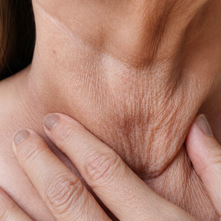 Close-up of a woman gently pinching loose, crepey skin on her neck, demonstrating neck laxity and the visible signs of collagen and elastin loss with aging.