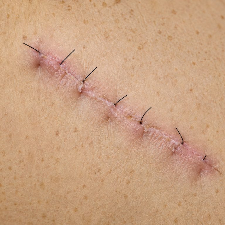 Fresh sutured surgical incision on the skin