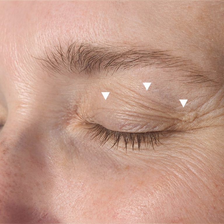 Upper eyelid laxity with arrows showing loose skin weighing down over the eyelid